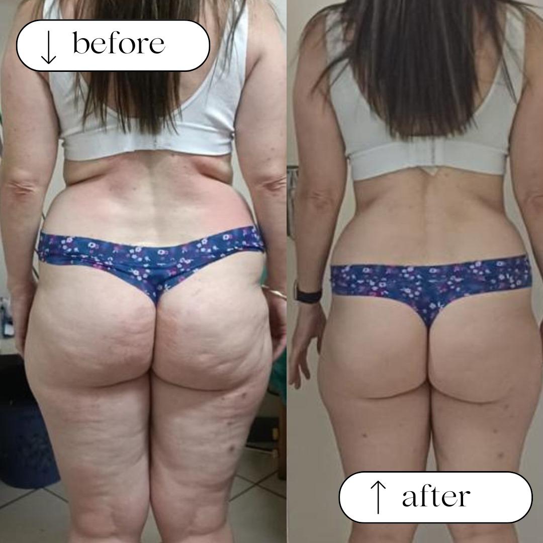 Liposculpt Day and Night sculpting set